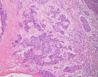 Case report: A kidney metastasis from vulvar squamous cell carcinoma